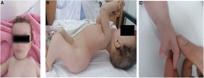 Case report: Exome sequencing revealed disease-causing variants in a patient with spondylospinal thoracic dysostosis